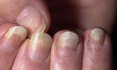 Зеленые ногти и заболевание псевдомония: причины, диагностика и варианты лечения
