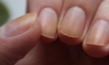 Причины расслоения ногтей и способы их лечения